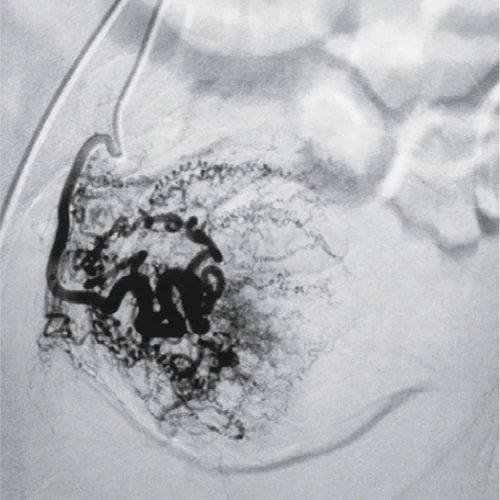 angiography system